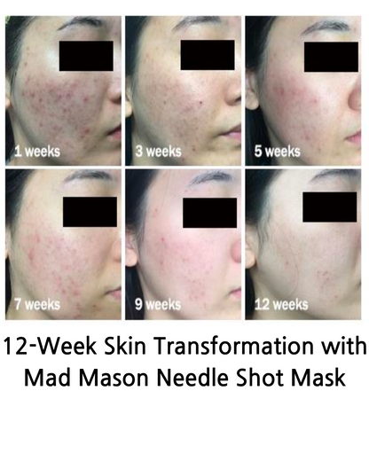 MadMason Needle 100 all in one Premium Mask Pack